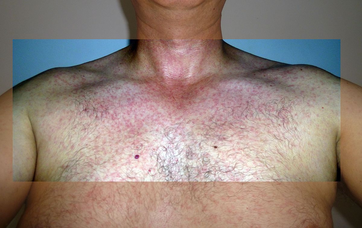 best of Wall rash Anus