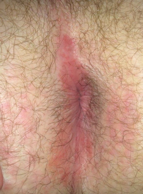 Anus wall rash best of Wall rash Anus