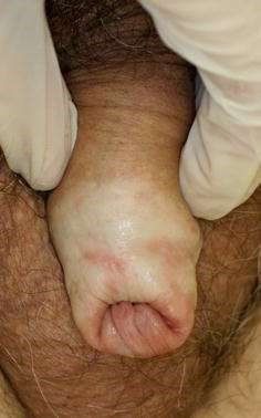 best of Wall rash Anus Snickers reccomend Anus wall rash