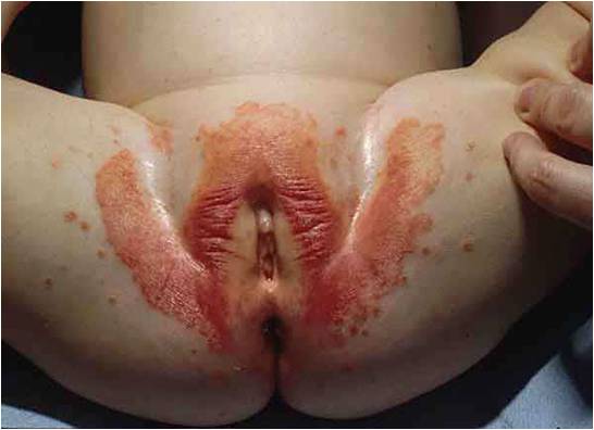 best of Wall rash Anus Anus wall rash