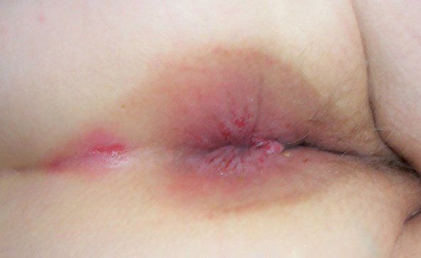 Lightening B. reccomend Anus wall rash